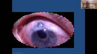 Glaucoma Surgeries Webinar screenshot 4