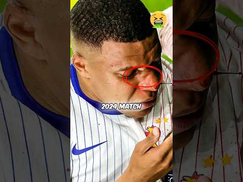 Mbappe's Broke His