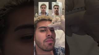 Getting filler & botox for the 11 lines is one of the most common beauty procedures for men.