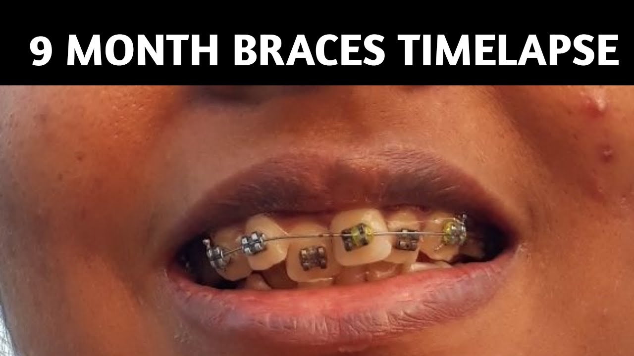 Braces 9 Month Timelapse Smile Transformation!! YouTube