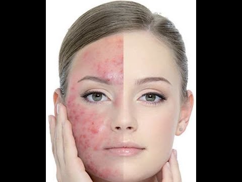 can you get acne on your vag , can tea cause acne , can ovarian cysts cause acne