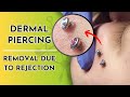 Dermal piercings  removal due to rejection 