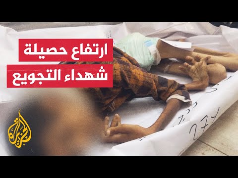 3 وفيات بينهم طفلان نتيجة سوء التغذية والاحتلال يقتل 49 من منتظري المساعدات في غزة