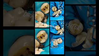 Single Visit Endodontic Treatment For Lower First Molar