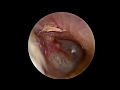 Endoscopic stapes surgery dr guevara nicolas iufc chu nice