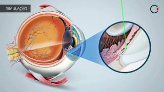 Tratamentos para o Glaucoma: LASER SLT