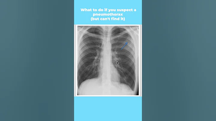 What to do if you suspect a pneumothorax (but can't find it) #shorts