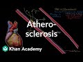 Atherosclerosis | Circulatory System and Disease | NCLEX-RN | Khan Academy