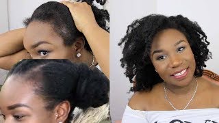 Postpartum Hair Loss & Shedding | 10 Months Hair Update