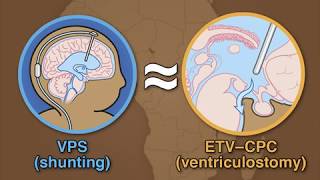 Treatment for Postinfectious Hydrocephalus in Infants