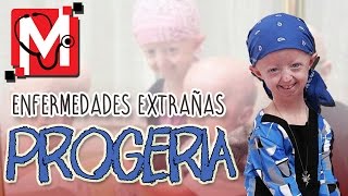 Enfermedades extrañas: Progeria