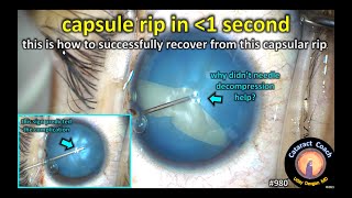 Capsule Rip during intumescent white cataract surgery (Argentinian Flag Sign)