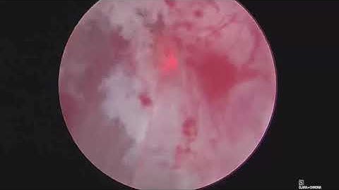 Holep en-bloc no touch technique early apical release.