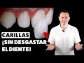 Carillas dentales ¡SIN DESGASTE! Una excelente opción | CASO REAL