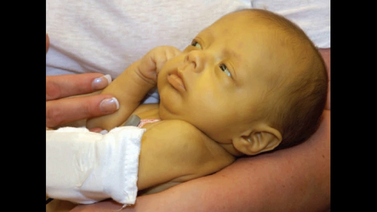 Почему новорожденный хрипит. Транзиторная желтуха новорожденных. Желтушка новорождённых гемолитическая болезнь. ГБН У новорожденных анемическая форма. Гемолитическая болезнь это желтуха.