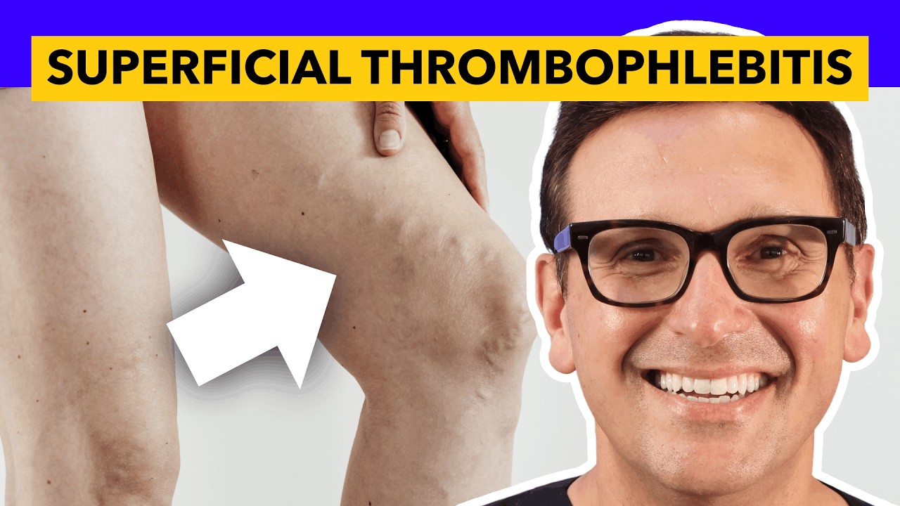 Superficial Thrombophlebitis: When a Varicose Vein Becomes a Medical Emergency