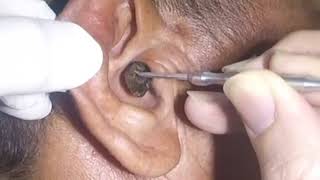 Removing MASSIVE Earwax from Man&#39;s Ear