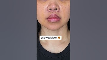 Lip Lift Surgery Results #plasticsurgery #plasticsurgeon #beforeandafter