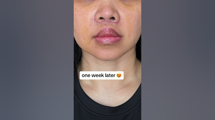 Lip Lift Surgery Results #plasticsurgery #plasticsurgeon #beforeandafter
