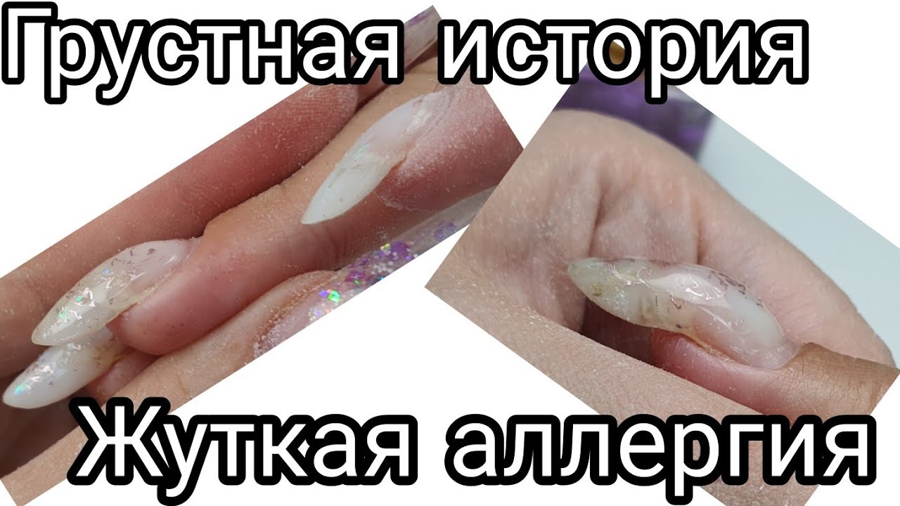 Аллергия у мастера маникюра. Аллергия на гель лак для ногтей. Аллергическая реакция на гель лак. Аллергия на ногтях от гель лака.