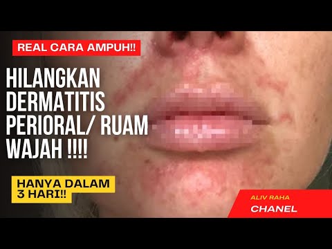 Video: Cara Mudah Mengobati Dermatitis Perioral: 8 Langkah (Dengan Gambar)