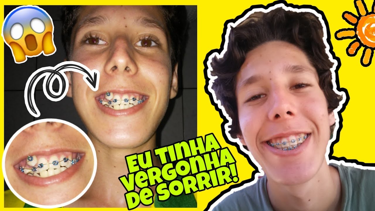 Featured image of post Dente Encavalado Com Aparelho Antes E Depois O aparelho ortod ntico ou aparelho dent rio comumente chamado apenas de aparelho um dispositivo utilizado por ortodontistas em seus pacientes para fazer o alinhamento dos dentes quando eles se desenvolvem com uma m forma o