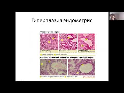 Гиперпластические процессы эндометрия. Рак тела матки (канд.мед.наук, доцент Т.Л.Смирнова).