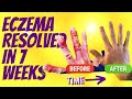 A lifetime of eczema resolved in 7 weeks