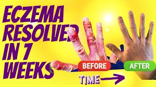 A Lifetime of Eczema Resolved in 7 Weeks...