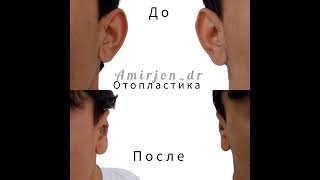 Идеальная Отопластика для консультация напишите WhatsApp+992208469292