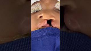 Best cleft lip repair - before and after