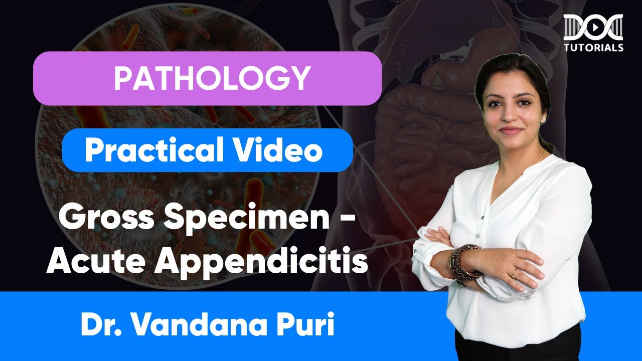 Gross Specimen – Acute Appendicitis | Pathology Practical | Dr. Vandana Puri | DocTutorials MBBS