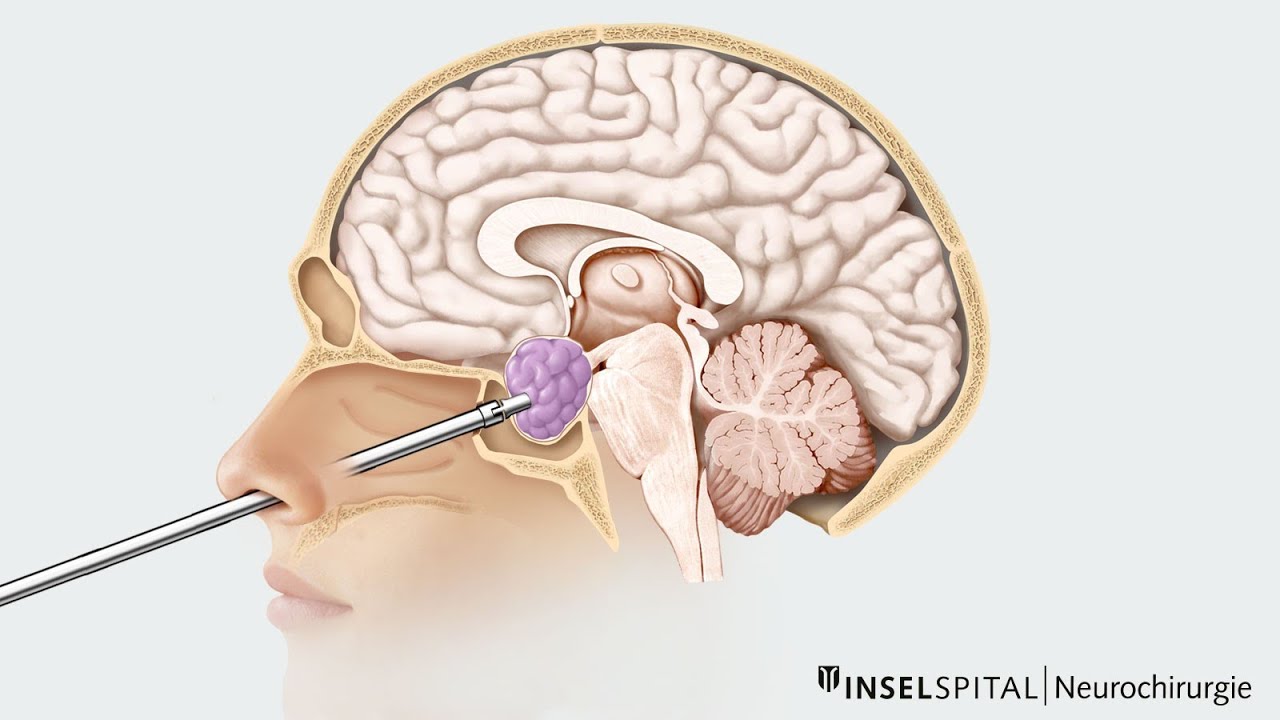 Endocrinologie - Adenome Hypophysaire [FMPC]