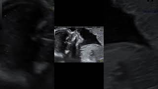 клинический случай Оценка носовой кости во 2 триместре скрининга?