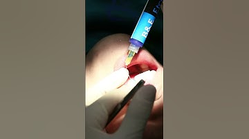 Có thể tháo niềng và lắp răng sứ cùng lúc không? Bí mật mà bạn chưa biết! | Dr Cường Official