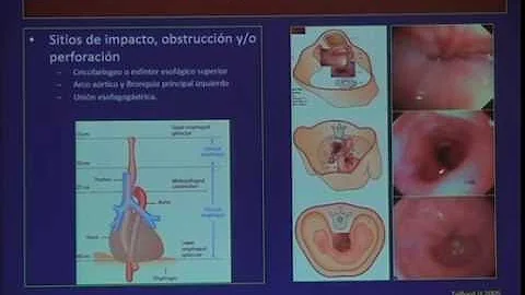 ¿Cuál es la localización más frecuente de un cuerpo extraño aspirado?