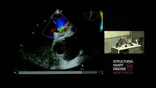 Extracorporeal Membrane Oxygenation for Acute Pulmonary Embolism - A/Prof Paul Forrest