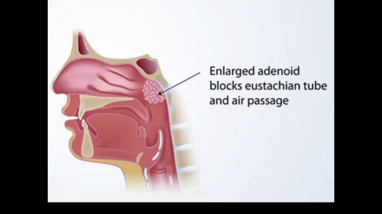Где аденоиды у ребенка