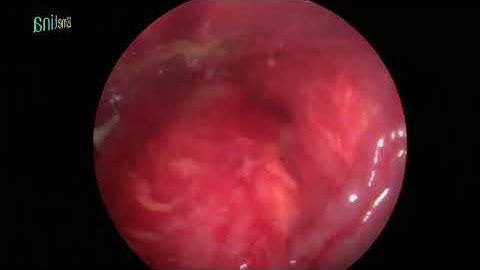 Kiến thức nâng ngực|Nâng ngực nội soi đường nách, túi Ergonomix cho khách hàng ở Đồng Tháp