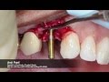 Onestage surgery using tapered internal plus dental implant from biohorizons