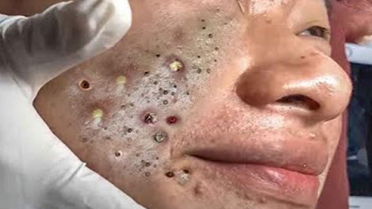 𝑪𝒚𝒔𝒕𝒊𝒄 𝑨𝒄𝒏𝒆 𝑹𝒆𝒎𝒐𝒗𝒂𝒍 & 𝑰𝒏𝒇𝒍𝒂𝒎𝒎𝒂𝒕𝒐𝒓𝒚 𝑨𝒄𝒏𝒆 #𝟖𝟔𝟖𝟔𝟕𝟓