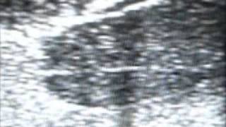 YEZITRONIX.COM Prostate Phantom Neddle.wmv