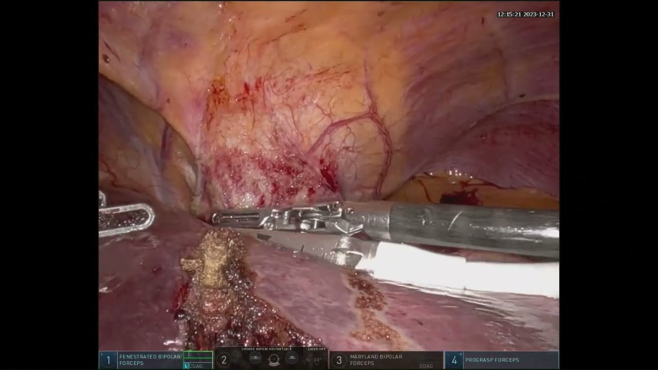 Robotic Right hepatectomy for a large HCC