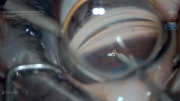 Performing a goniotomy procedure with the SION Surgical Instrument