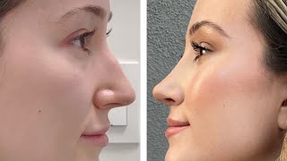 NOSE JOB VLOG 2022: *HONEST* CLOSED RHINOPLASTY EXPERIENCE: Cost, Recovery, Worth It...!?