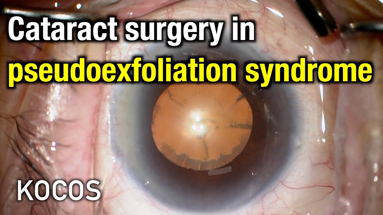 Cataract Surgery In Pseudoexfoliation Syndrome YouTube cataract-surgery-in-pseudoexfoliation-syndrome-youtube