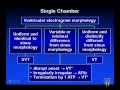 ICD Troubleshooting - Dr. Friedman, Mayo Clinic