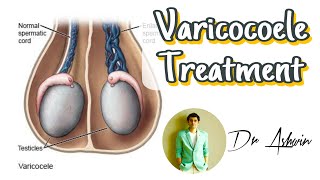 Varicocele | Treatment || sperm | count | motility | pregnancy | Dr Ashwin | natural | KJK Hospital