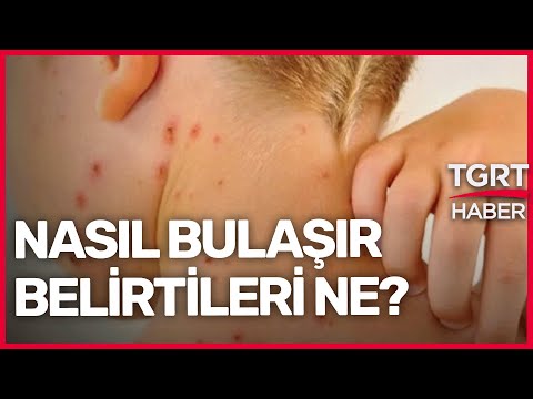 Maymun Çiçeği'nin Belirtileri neler? Nasıl Bulaşır? Covid'den Farkı Ne? - TGRT Haber