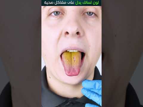 لون لسانك علامة على مشاكل صحية خطيرة 